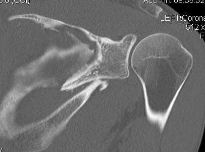 Glenoid Neck Fracture